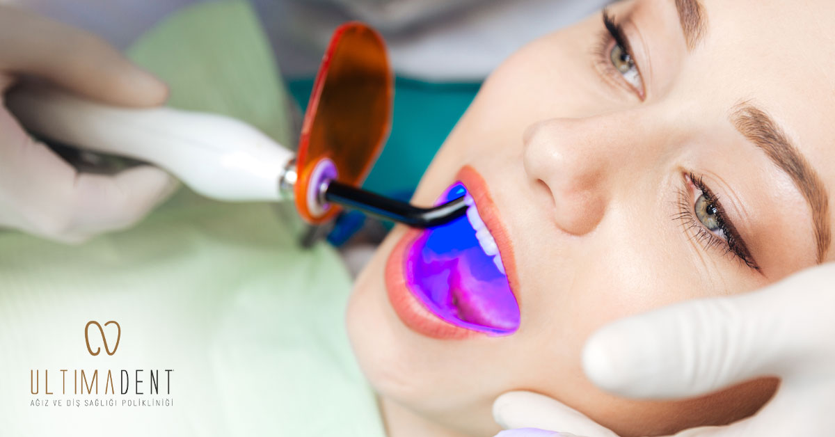 Que faut-il considérer après le blanchiment des dents?