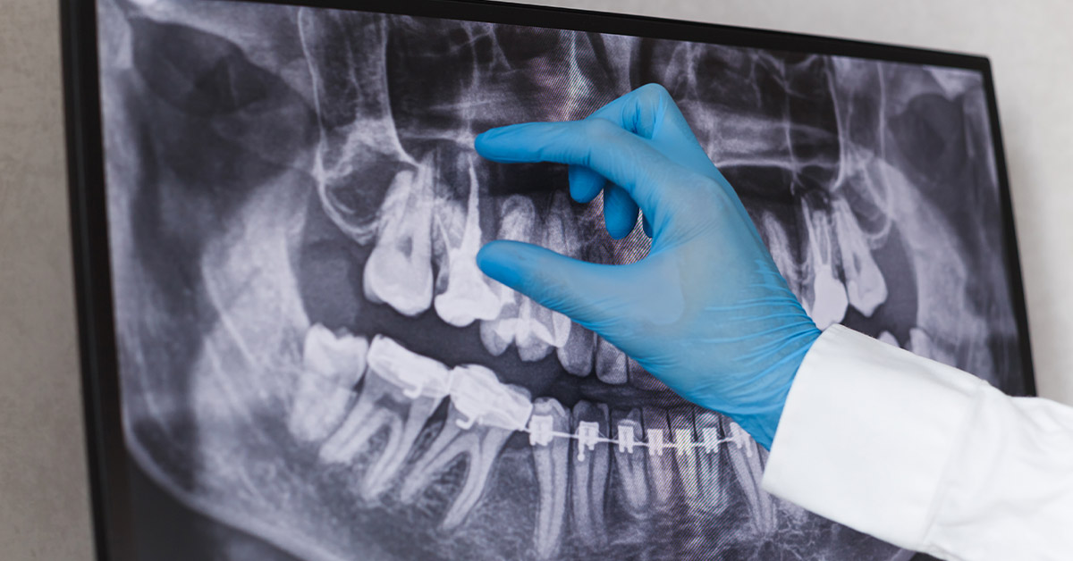 Ön Dişlerde Kanal Tedavisi Hakkında Bilmeniz Gerekenler