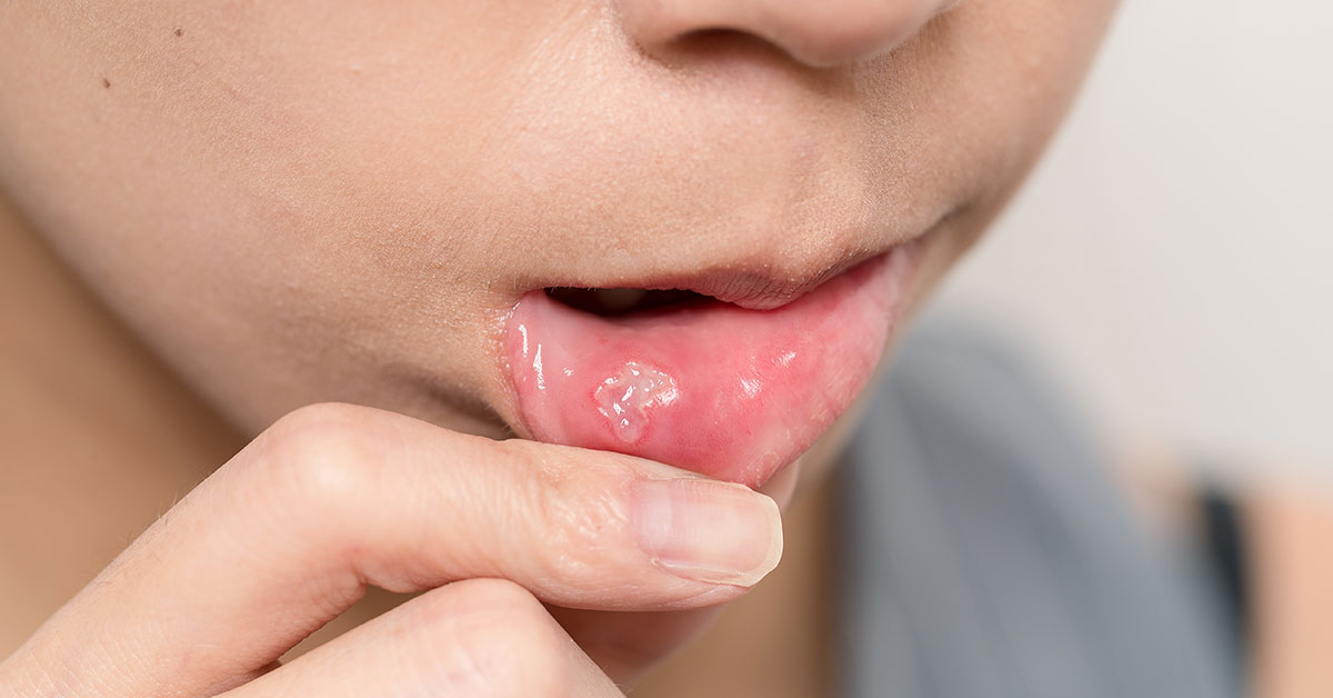 Comment traiter le saignement persistant des gencives ?